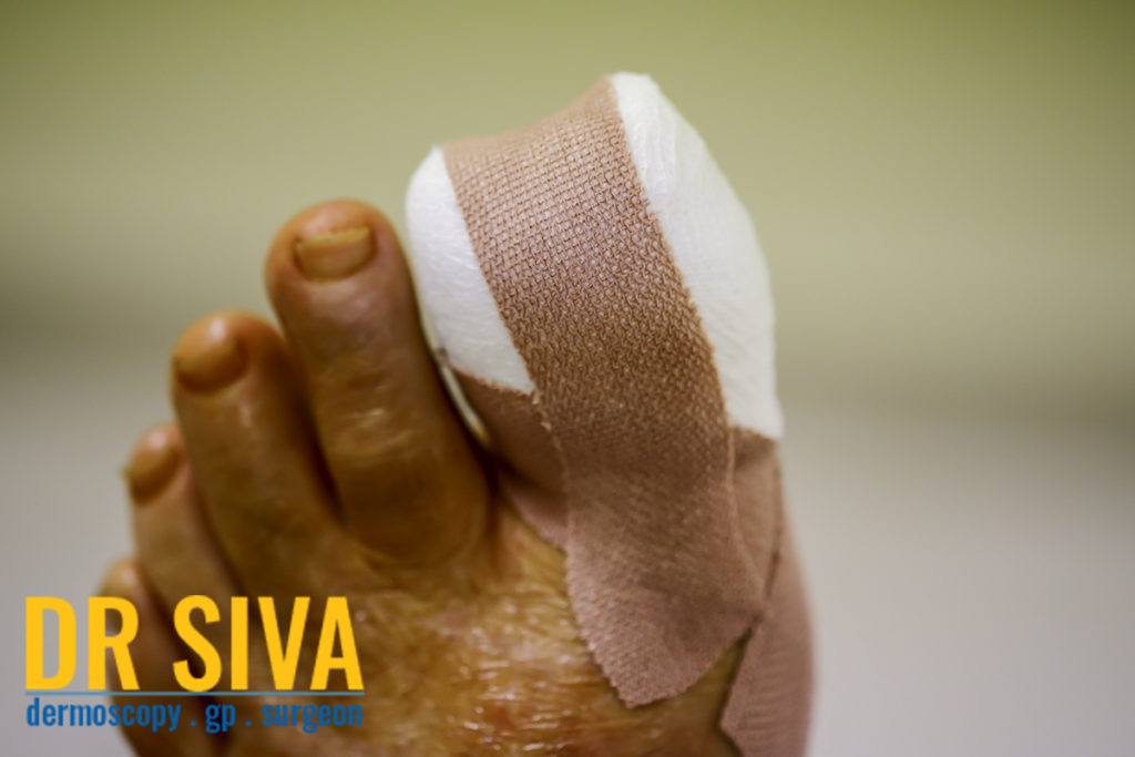 How To Fix Ingrown Toenails - Acacia Ridge Family Practice