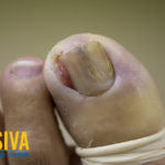 Ingrown Toe Nail Wedge Excision