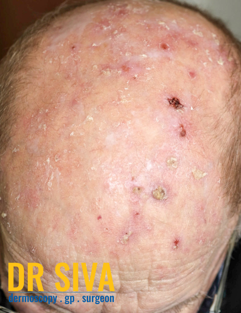 Actinic Keratosis (AK) scalp pictures